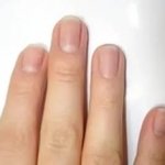Онихомикоз (onychomycosis, tinea unguium, ringwarm of the nails)