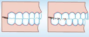 Патологическое стискивание зубов
